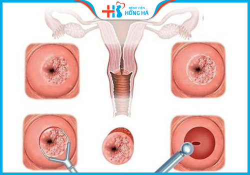 phương pháp rfa điều trị viêm lộ tuyến cổ tử cung