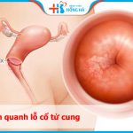 Viêm quanh lỗ cổ tử cung: Tác động đến tới 30% phụ nữ và cách phòng ngừa