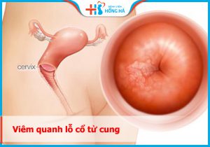 Viêm quanh lỗ cổ tử cung: Tác động đến tới 30% phụ nữ và cách phòng ngừa