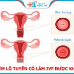 Bị viêm lộ tuyến có làm IVF được không? 7 Điều cần ghi nhớ