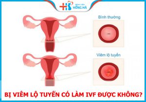 Bị viêm lộ tuyến có làm IVF được không? 7 Điều cần ghi nhớ