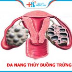 Nang đa thùy ảnh buồng trứng hưởng tới 10% phụ nữ trong độ tuổi sinh sản