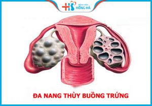 Nang đa thùy ảnh buồng trứng hưởng tới 10% phụ nữ trong độ tuổi sinh sản