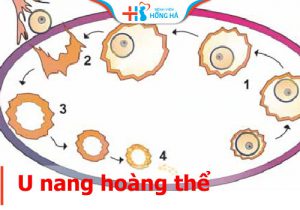 Nang hoàng thể trong thai kỳ: Nguyên nhân, triệu chứng và liệu trình điều trị