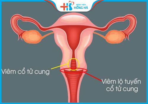viêm lộ tuyến có sinh thường được không