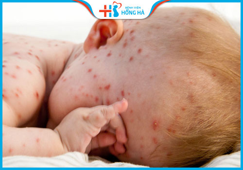thủy đậu vô sinh trẻ sơ sinh