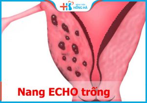 Nang Echo trống: Tầm quan trọng của việc phát hiện sớm và điều trị.