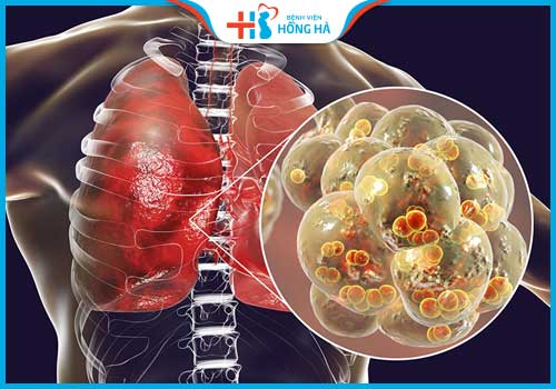thủy đậu có vô sinh không viêm phổi