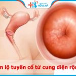 Viêm lộ tuyến cổ tử cung diện rộng: nguyên nhân, triệu chứng và điều trị