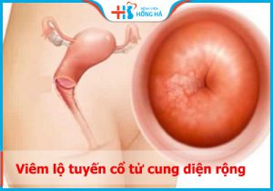 Viêm lộ tuyến cổ tử cung diện rộng: nguyên nhân, triệu chứng và điều trị
