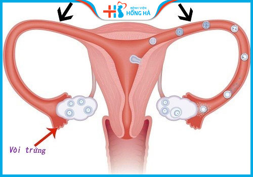 bị đa nang buồng trứng có làm iui được không