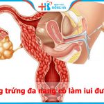 Mắc buồng trứng đa nang có làm IUI được không? Ai có thể thực hiện IUI tốt