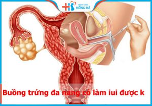 Mắc buồng trứng đa nang có làm IUI được không? Ai có thể thực hiện IUI tốt