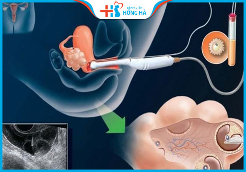 buồng trứng đa nang nên làm iui hay ivf