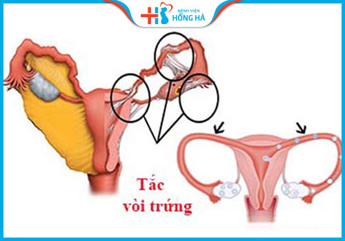 nguyên nhân gây vô sinh do ống dẫn trứng