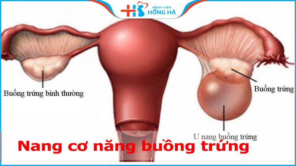 Nang cơ năng buồng trứng: Phương pháp chữa trị hiệu quả cho 5% phụ nữ