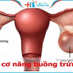 Nang cơ năng buồng trứng: Phương pháp chữa trị hiệu quả cho 5% phụ nữ