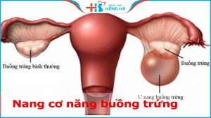 Nang cơ năng buồng trứng: Phương pháp chữa trị hiệu quả cho 5% phụ nữ