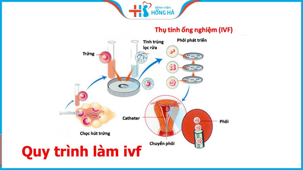 Quy trình làm IVF bao gồm bao nhiêu bước cơ bản