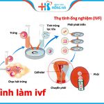 Quy trình làm IVF bao gồm bao nhiêu bước cơ bản