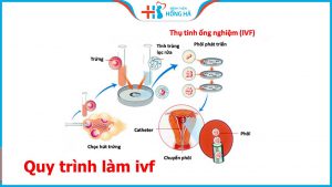 Quy trình làm IVF bao gồm bao nhiêu bước cơ bản