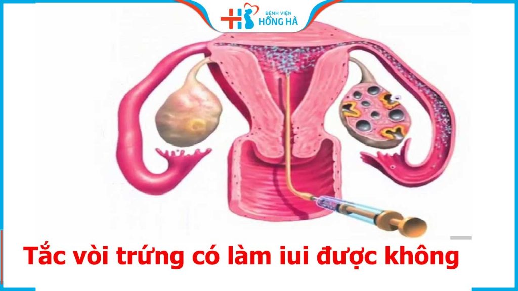 Tác động tắc vòi trứng đến IUI: Tỷ lệ thành công và thất bại