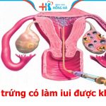Tác động tắc vòi trứng đến IUI: Tỷ lệ thành công và thất bại