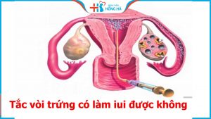 Tác động tắc vòi trứng đến IUI: Tỷ lệ thành công và thất bại