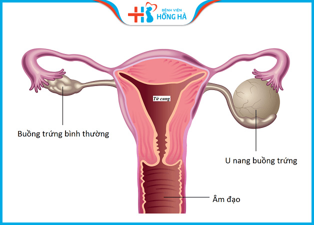Bệnh u nang buồng trứng cơ năng ở phụ nữ