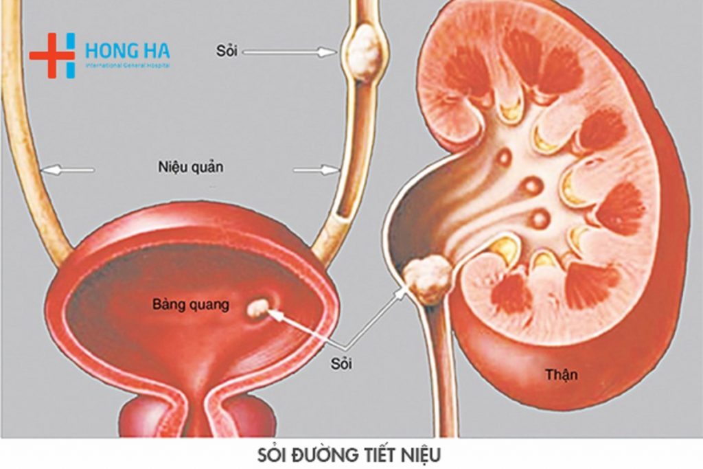 Kích thước sỏi niệu quản và chế độ ăn phù hợp