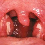 Viêm amidan hốc mủ : dấu hiệu, nguyên nhân và phương pháp điều trị