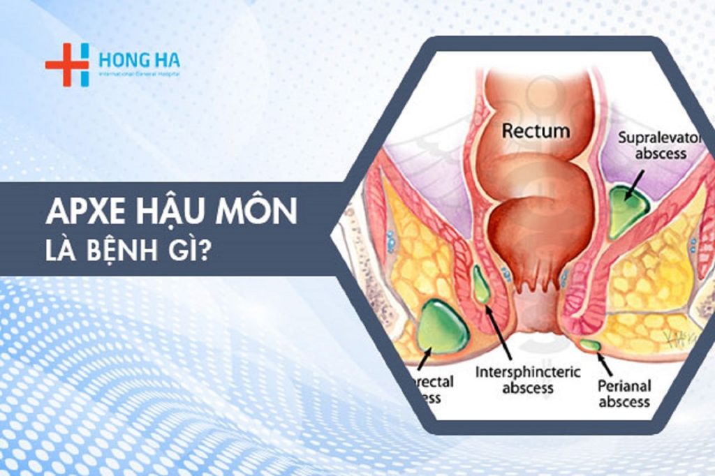 Apxe Hậu Môn: Nguyên Nhân Và Phương Pháp Điều Trị