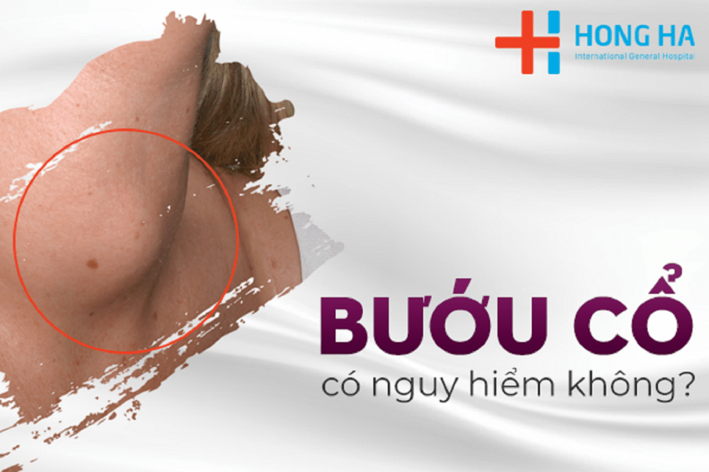 Bệnh bướu cổ dấu hiệu nguyên nhân và cách điều trị