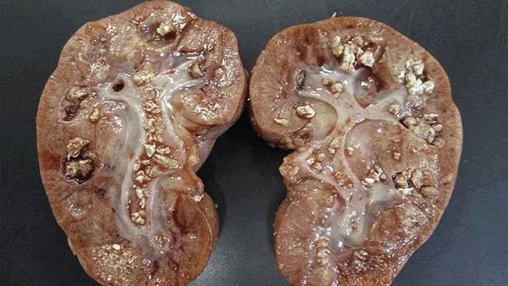 Sỏi thận: Dấu hiệu, nguyên nhân và cách điều trị