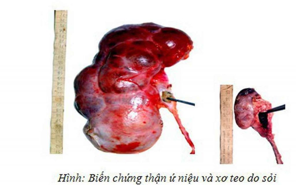 Sỏi Thận Và Những Biến Chứng Nguy Hiểm