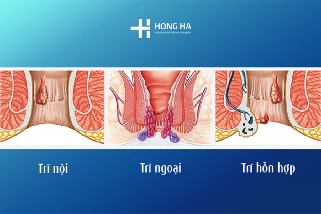 Bệnh trĩ: Dấu hiệu, nguyên nhân, cách điều trị bệnh trĩ