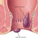 Trĩ hỗn hợp là bệnh gì? Điều trị trĩ như thế nào?