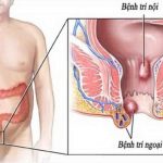 Trĩ ngoại: Dấu hiệu, nguyên nhân, cách điều trị