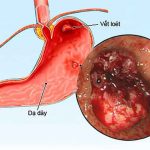 Viêm Loét Dạ Dày: Nguyên Nhân và Cách Điều Trị Bệnh