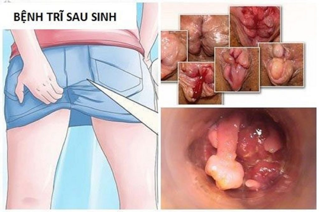 Bị trĩ sau sinh – Phải làm sao?