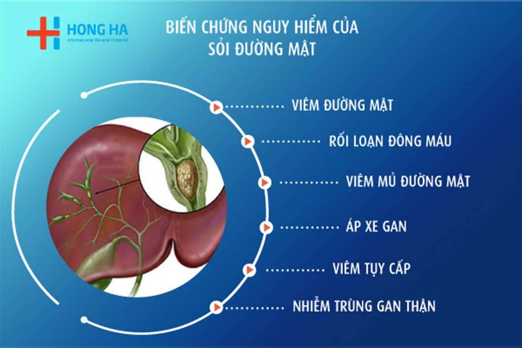 Sỏi Túi Mật: Kẻ Giết Người Thầm Lặng