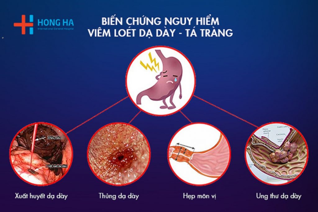 Những Biến Chứng Nguy Hiểm của Bệnh Viêm Loét Dạ Dày