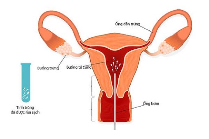 Bơm tinh trùng vào cổ tử cung