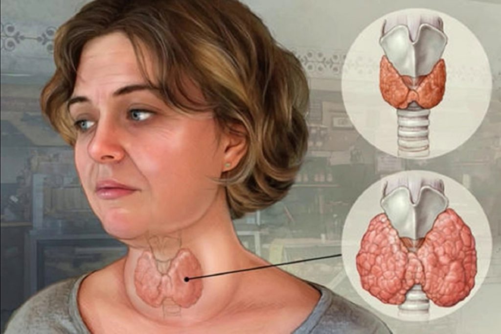 Bướu cổ: Dấu hiệu, nguyên nhân và cách điều trị bệnh