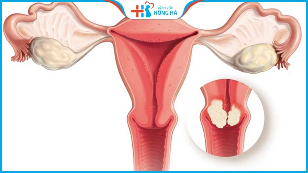 Bà bầu bị co bóp tử cung sau chuyển phôi có nguy hiểm không