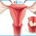 Bà bầu bị co bóp tử cung sau chuyển phôi có nguy hiểm không