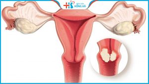 Bà bầu bị co bóp tử cung sau chuyển phôi có nguy hiểm không