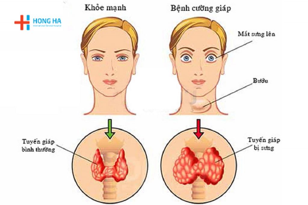 Cường giáp: Dấu hiệu, nguyên nhân và cách điều trị bệnh