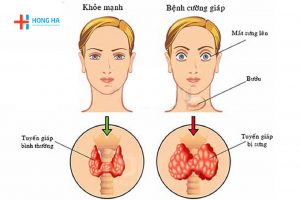 Cường giáp: Dấu hiệu, nguyên nhân và cách điều trị bệnh