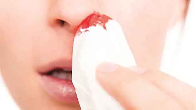Những triệu chứng nhận biết bệnh polyp mũi